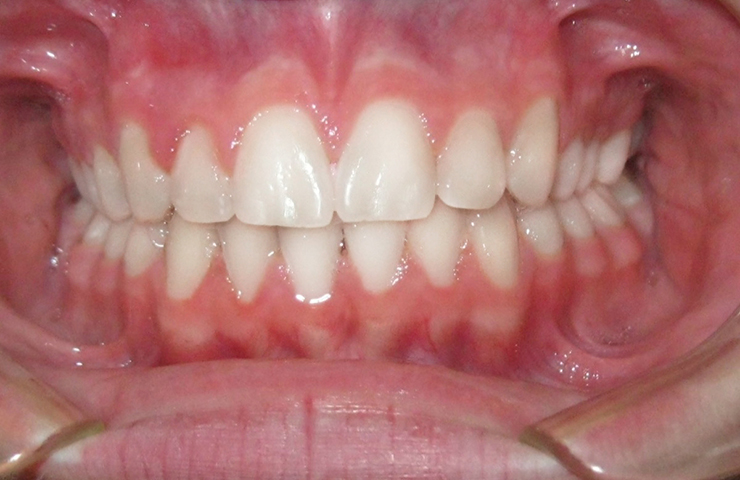 Crowding Before and After Straightening Teeth Pictures