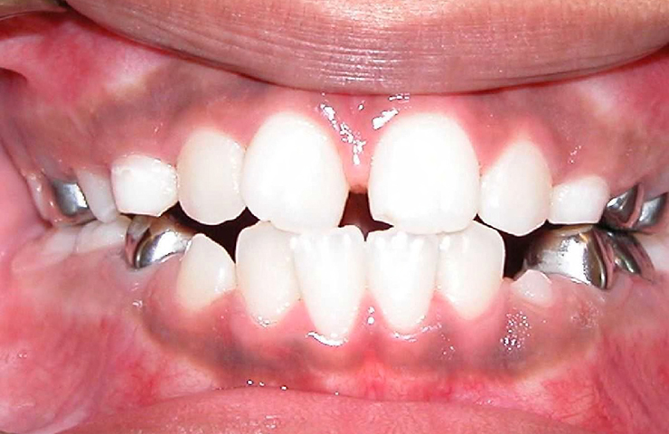 Crowded Teeth Before and After Straightening Teeth