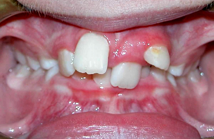 Crowded Teeth Before and After Braces Photos