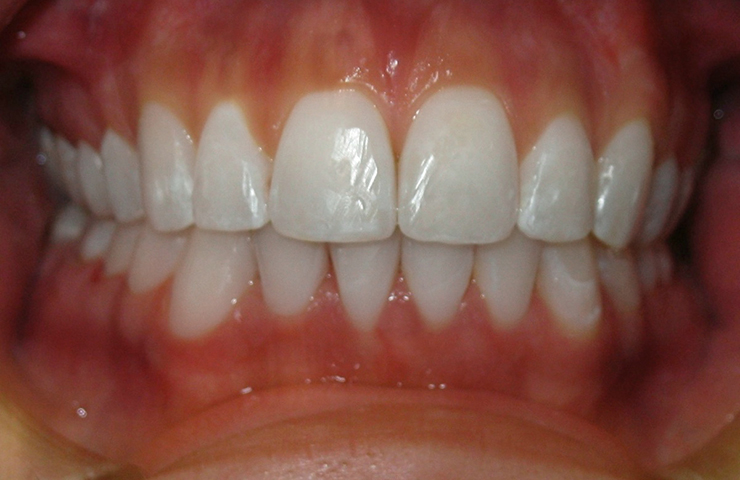 before crowding teeth crowded braces invisalign patient orthodontics