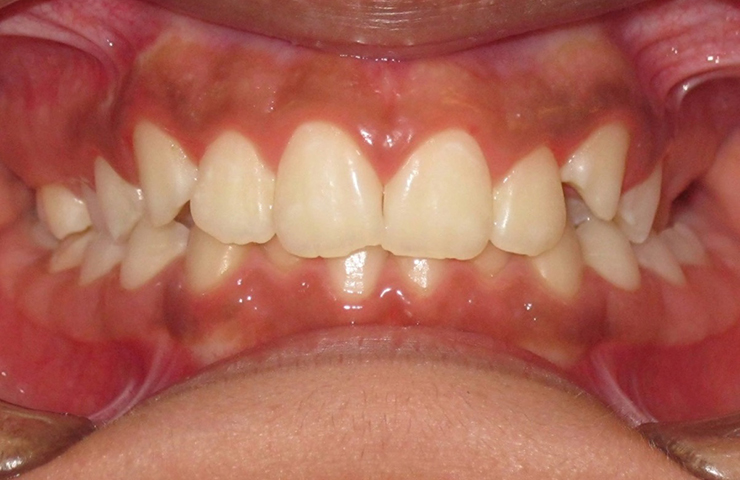 Overbite Before and After Invisalign Pictures