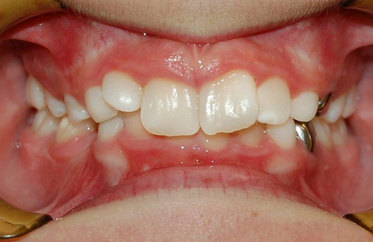 Deep Bite Before and After Orthodontic Treatment
