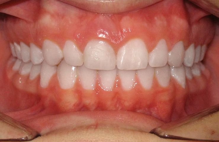 Overbite Before and After Orthodontic Treatment