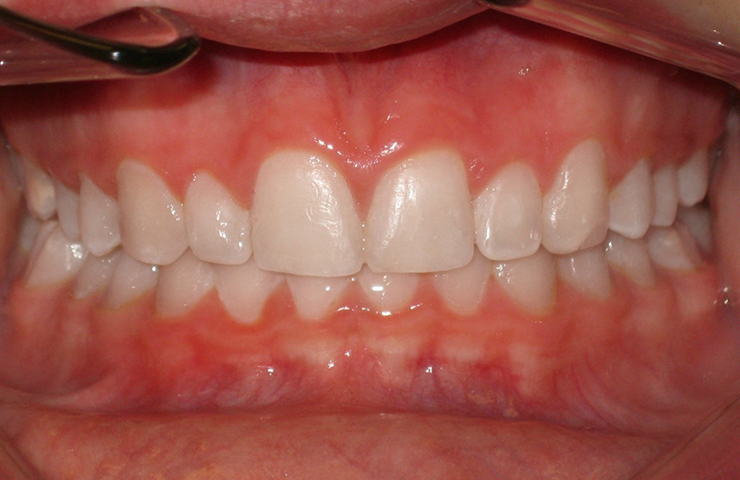 Overbite Before and After Orthodontic Treatment pictures