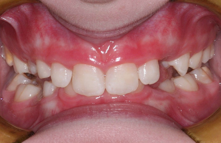 Overbite Before and After Orthodontic Treatment Photos