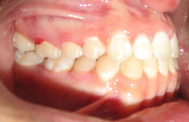 Overbite Before and After Straightening Teeth
