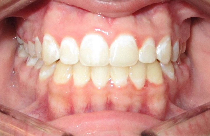 Deep Bite Before and After Straightening Teeth Photos