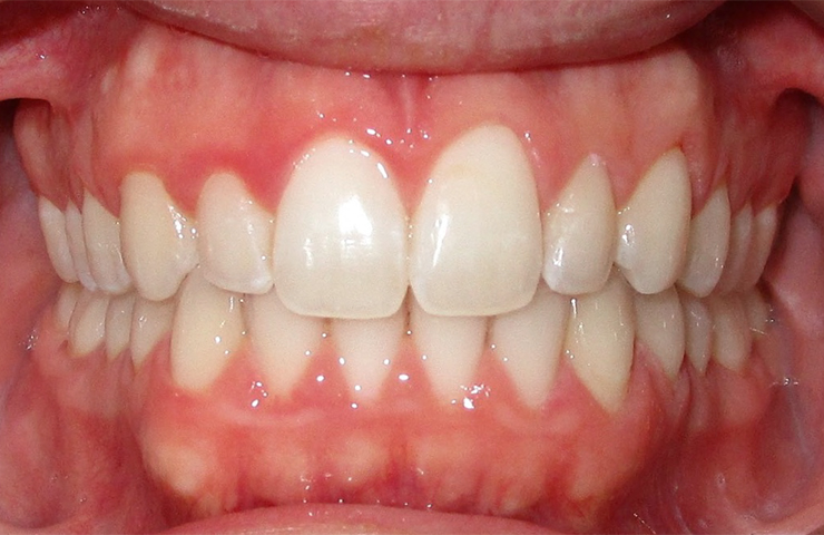 Smiles Before and After Invisalign