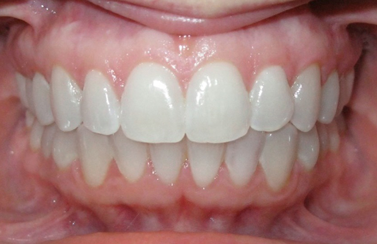 Before and After Invisalign Photos