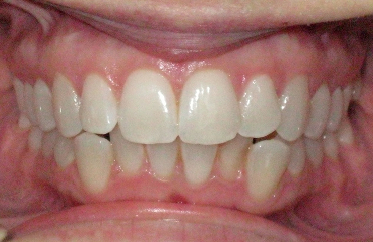 Before and After Invisalign Pictures