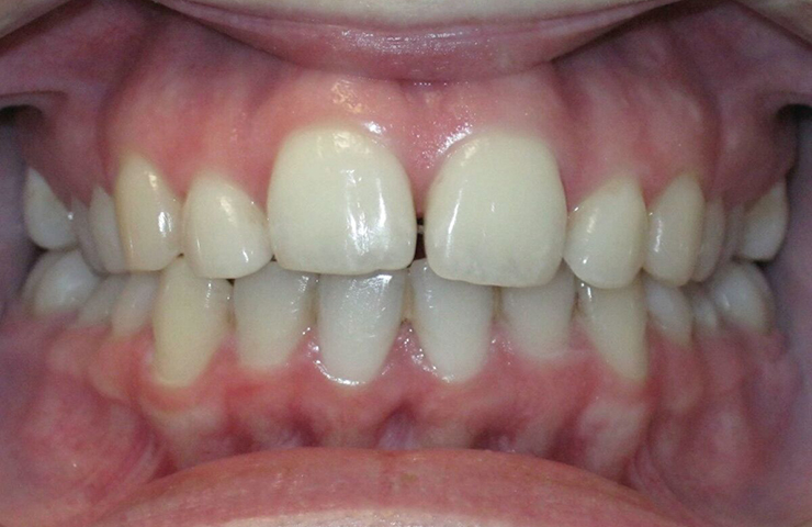 Invisalign Before and After Photos
