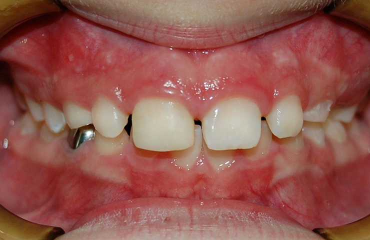 Spacing Before and After Orthodontic Treatment Photos