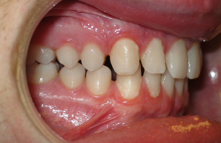 invisalign before and after spacing